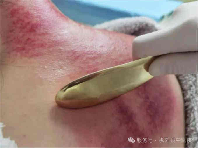 枞阳县中医院中医特色护理门诊开诊啦！